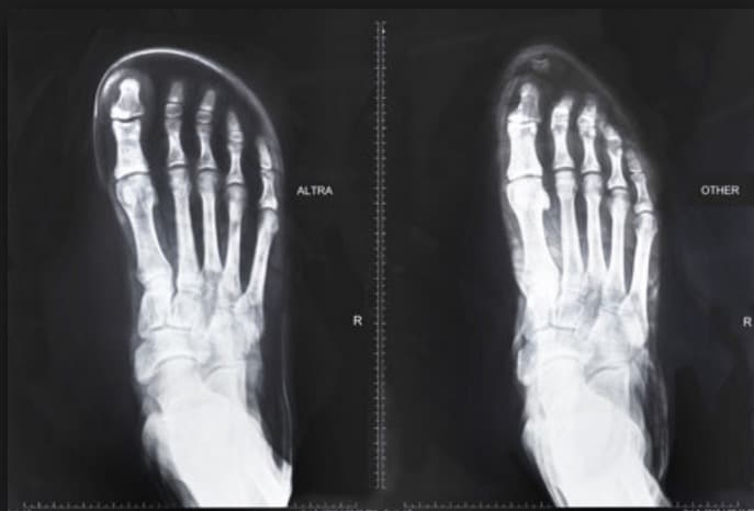 The Importance of Gait Analysis for Custom-Fit Shoes: Understanding Your Natural Movement for Improved Performance